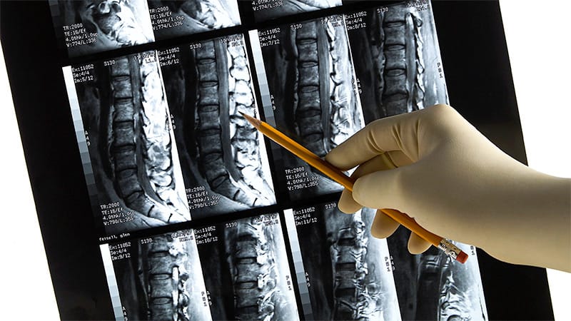 MRI Scans May Guide Treatment Decisions in axSpA