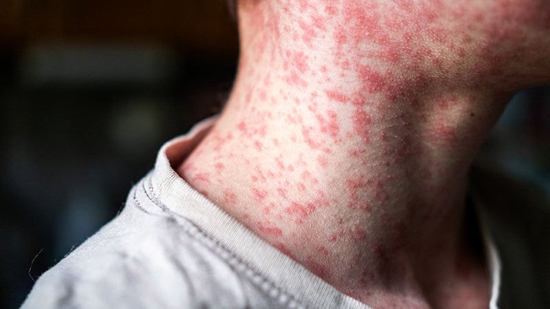 PAHO: Americas Lose Measles-Free Status as Cases Surge