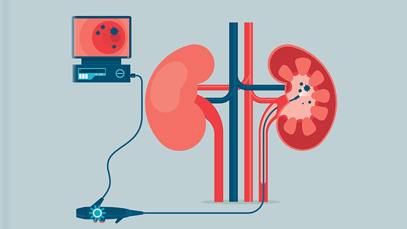 Ureteroscopy Safe and Effective for Stone Disease in Seniors
