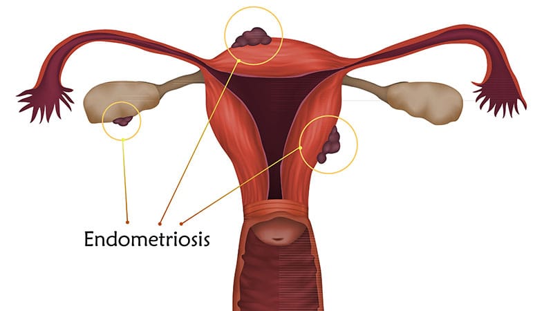 Distinct Risk Factor and Comorbidity Profiles Tied to Endometriosis Subtypes