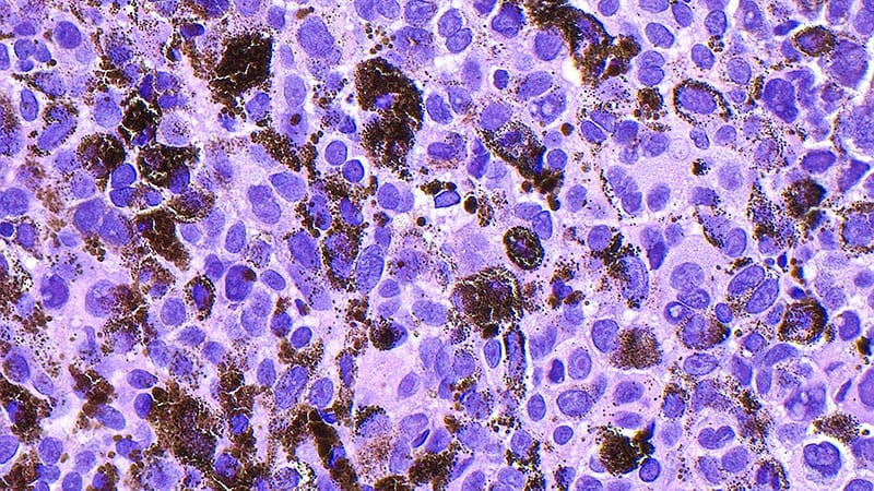 Vulvar Melanoma Outcomes Worse With Surgery Delay