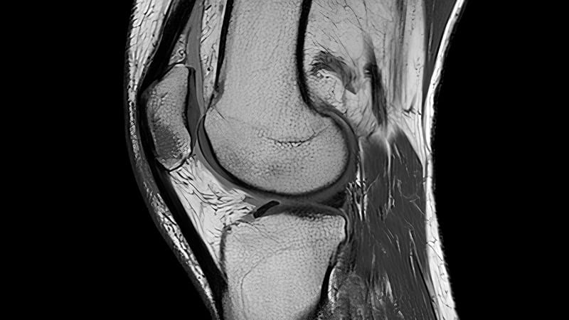 MRI Reveals Structural Changes Over Time in Knees Without OA