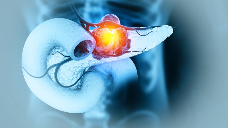 Clinical Trials Show Progress in Pancreatic Cancer Treatment