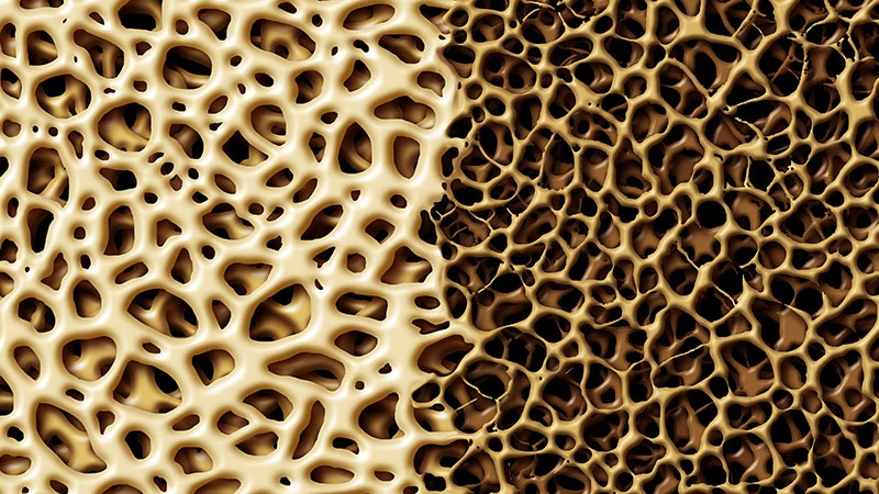 Drug Combo Boosts Bone Health in Postmenopausal Osteoporosis