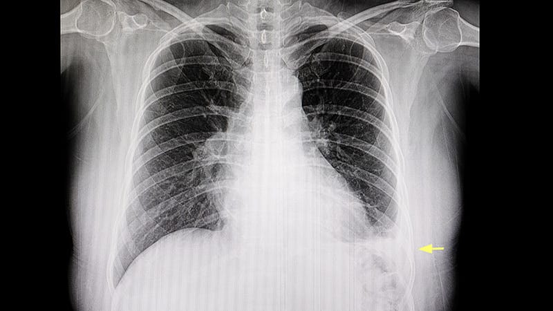 Saline Lavage Shows No Clinical Benefit in Pleural Infection