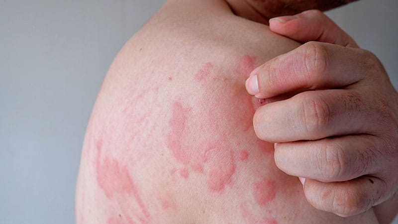 Remibrutinib Resolves Chronic Inducible Urticaria