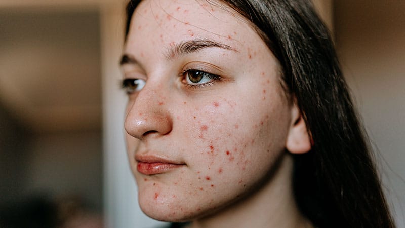 Topical Calcineurin Inhibitors Show No Lymphoma Signal