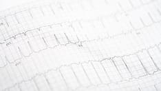 AF Pulsed Field Ablation Disappoints in Setup for Success
