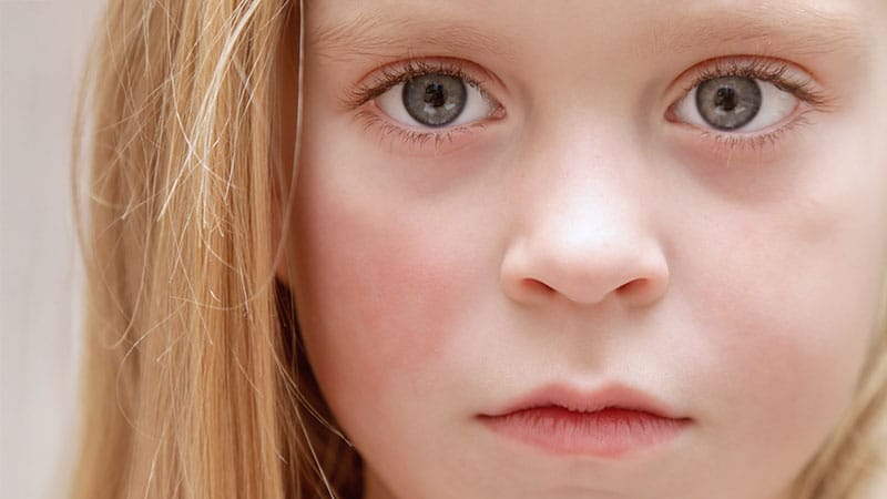 FLARE intervention improves child sun protection but not sunburns, study finds