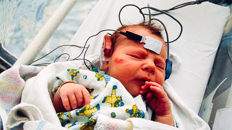 Neonatal Seizures Tied to Mortality and Disability by Age 5