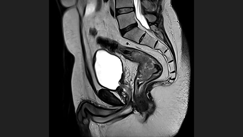 MRI Predicts Survival Better Than Pathology in Rectal Cancer
