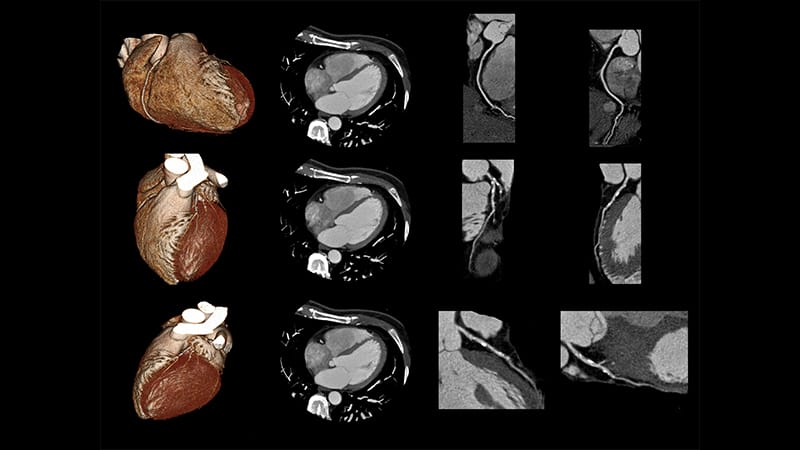 Updated HEART Score Enhances CAD Prediction Accuracy of CCTA