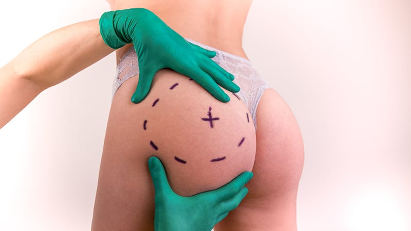 MPs Call for Immediate Ban on Brazilian Butt Lifts