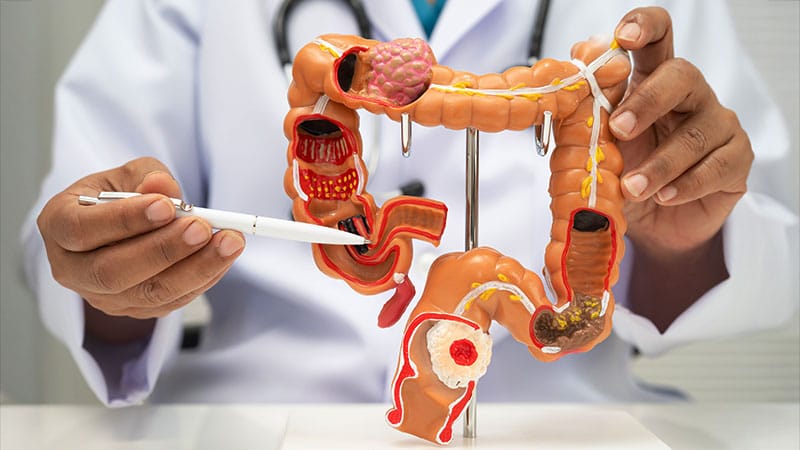 Canadian Group Calls for Earlier Colorectal Cancer Screening