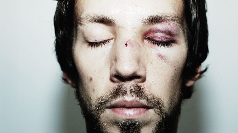 Fall-Related Eye Injuries Reveal Hidden Health Risks