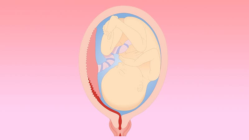 Placental Abruption Linked to Heart Disease in Teens