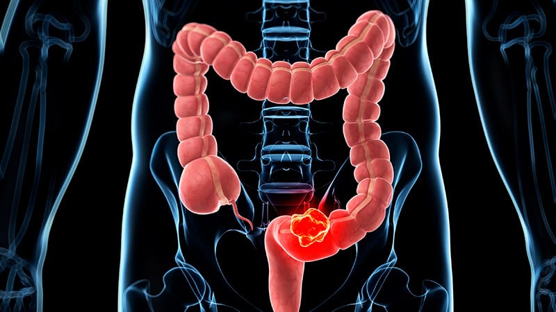 Vascular Complications Tied to Poor CRC Outcomes in Diabetes