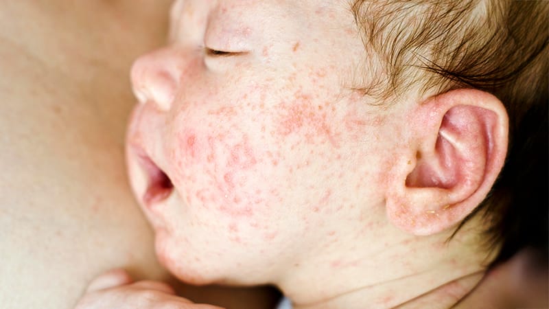 Biomarkers Track AD Severity in Children