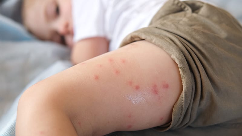 Maternal BMI and Birth Length Tied to Dermatitis Risk