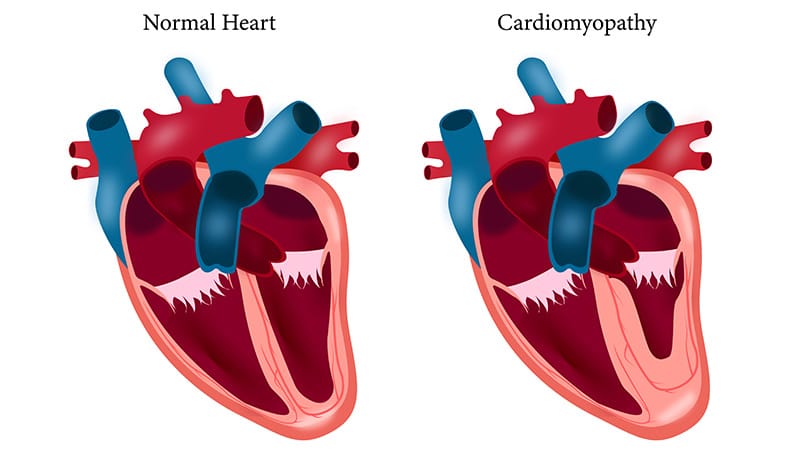Wall Thickness Heterogeneity Improves Cardiomyopathy Detection