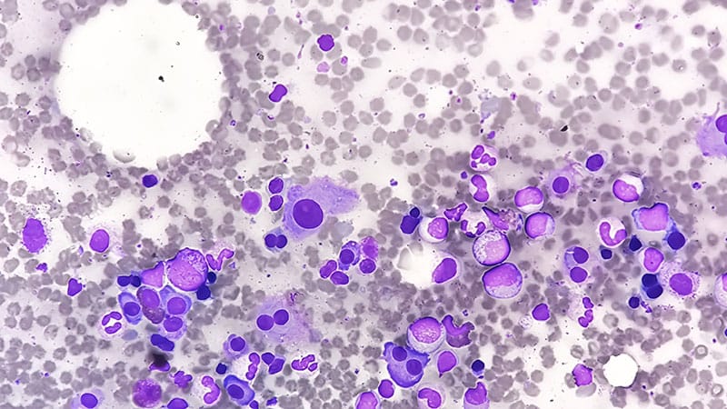 Which Risk Model Better Identifies High-Risk Smoldering MM?