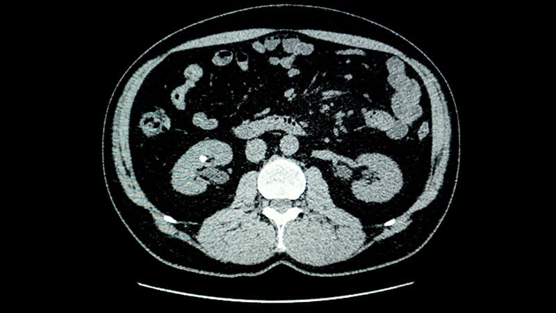 Photopenia on [18F]FDG PET/CT Predicts Benign Renal Lesions