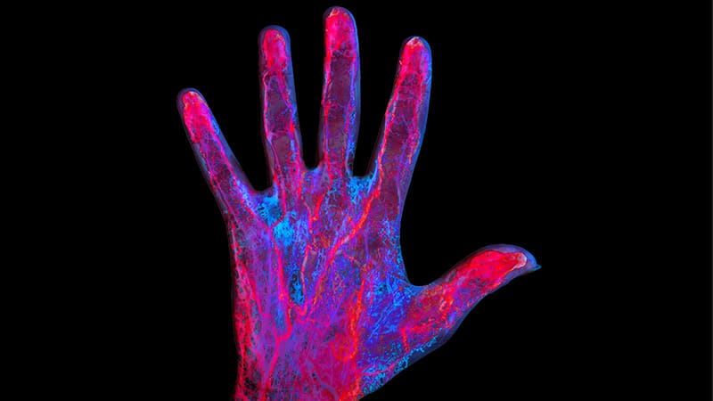 T2* MRI Maps Iron in Finger Soft Tissue in Microvasculopathy