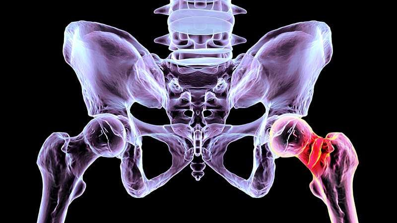 Danish Study Links Type 1 Diabetes to Femoral Fractures