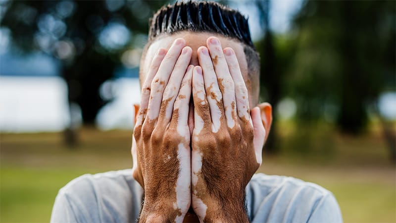 Does Distress in Skin Conditions Drive Suicidal Thoughts?