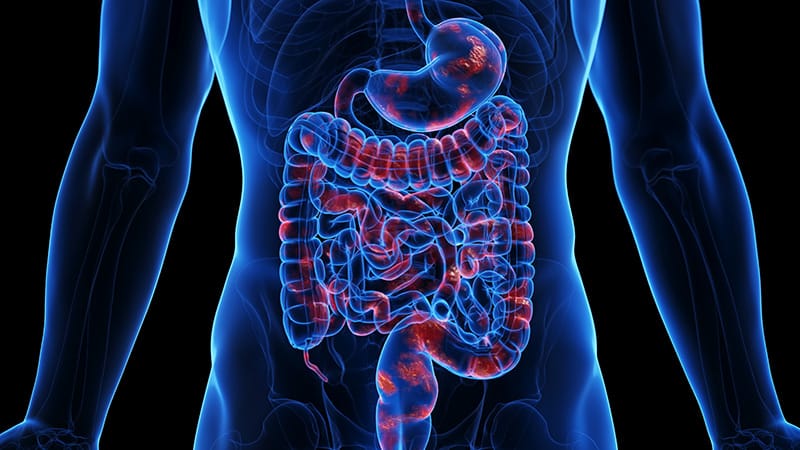 Real-World Data Show Efficacy of Risankizumab in Crohn's