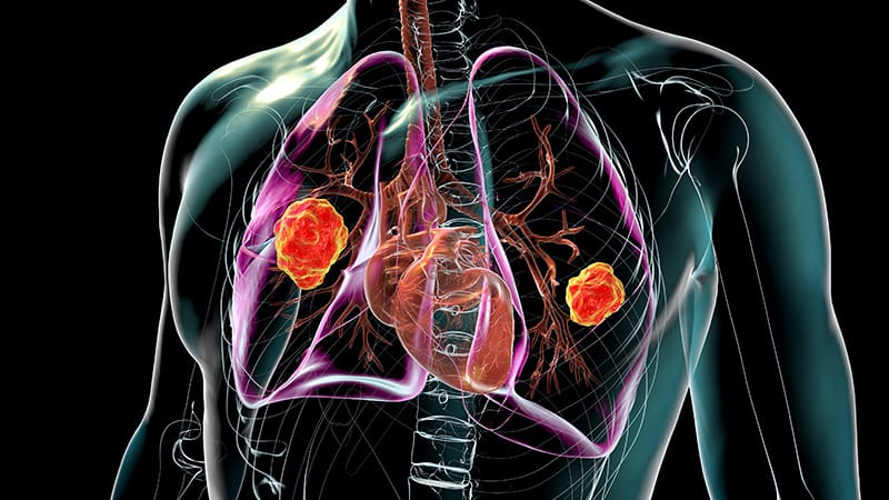 PCR Testing Identifies Infections in Lung Transplant Recipients