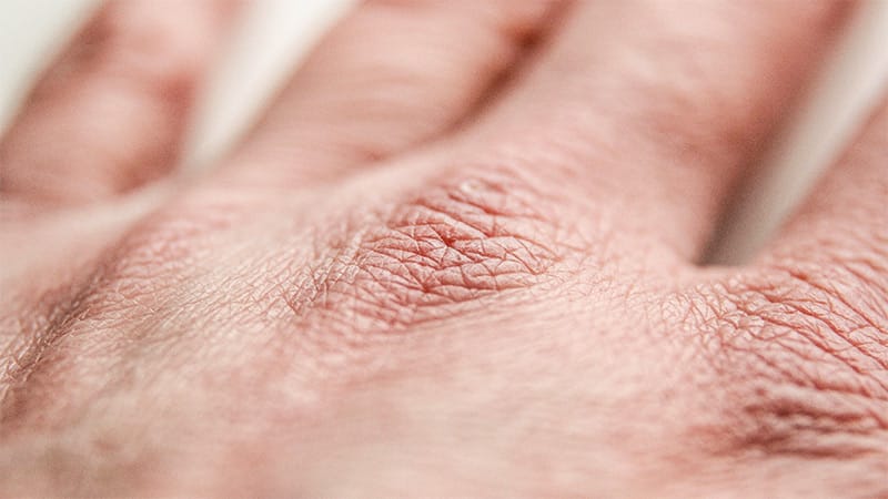 Dupilumab Can Restore Skin Nerve Density in Patients With AD
