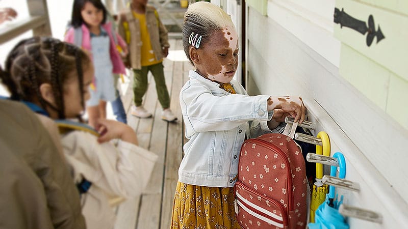 Registry Data Produce Insights About Pediatric Vitiligo Care