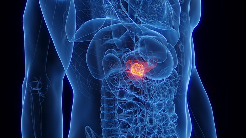 Lower Income Affects Pancreatic Cancer Tx, Survival