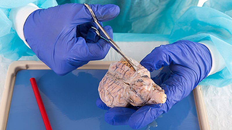 Estrogen-Only Menopausal HT Linked to Lower Alzheimer’s Risk