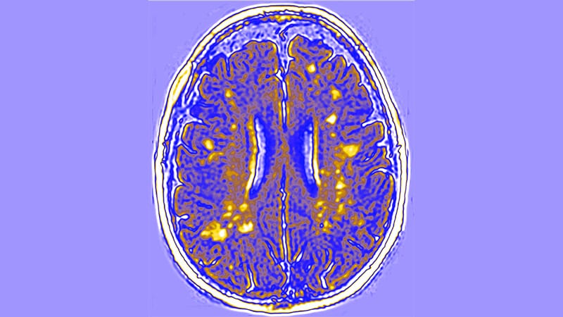 Old BP Med Promising as First Disease Modifier of Rare and Devastating Leukodystrophy