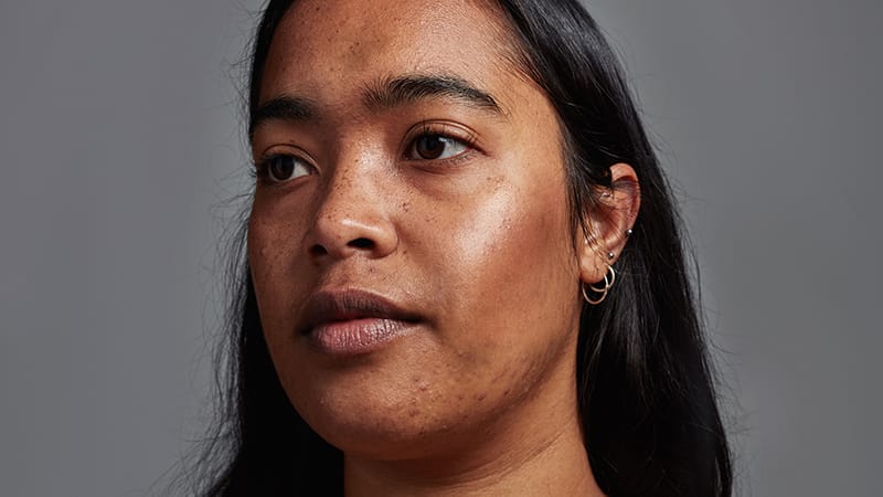 Does PIH Coexist With Skin Inflammation? Experts Weigh In