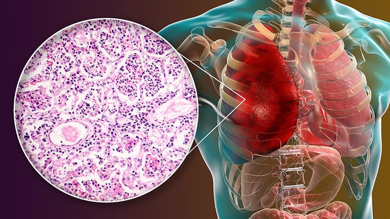 Transplant Recipients May Face Higher Endocarditis Mortality