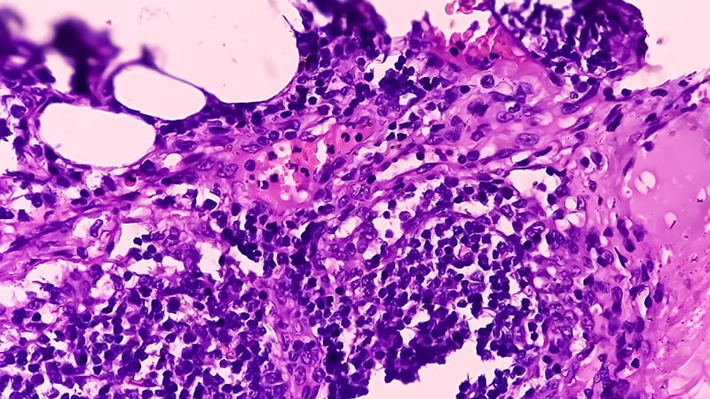 RET Fusion Linked to Occult Lymph Node Metastasis in PTC