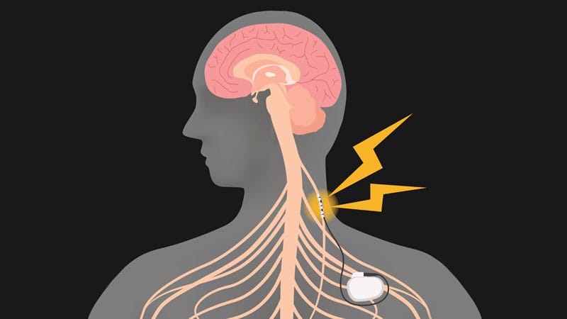 Vagus Nerve Stimulation Effective, Durable for Severe Treatment-Resistant ...