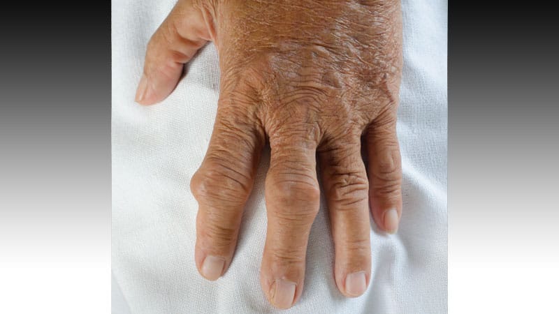 How Primary Care Can Catch Hidden Senior Joint Pain