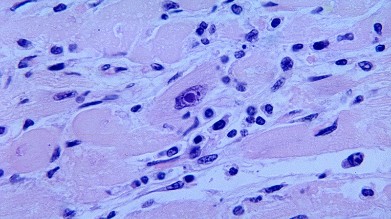 Study Shows Safety of Pharma-Grade CBD for Myocarditis
