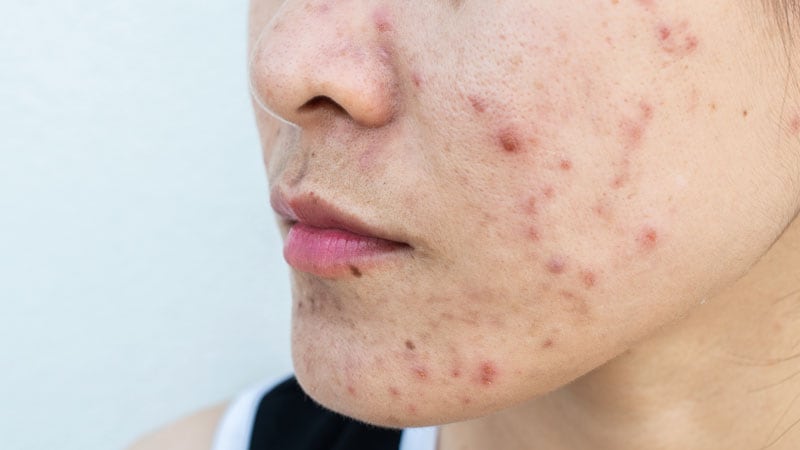 What's Behind Long-Term Antibiotic Prescribing for Acne?