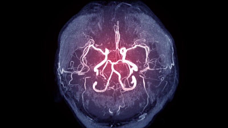 Novel Algorithm Boosts Stroke Triage, Outcomes Across the US