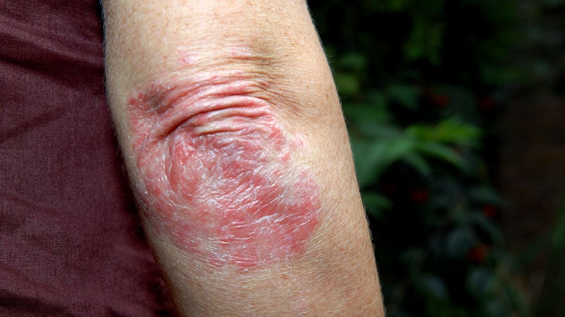 Adverse Events Differ Between Two Second-Line Psoriasis Rxs