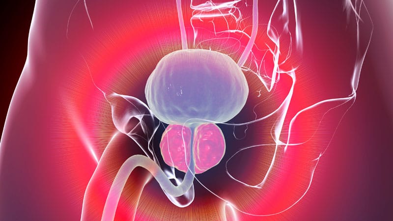 Medscape Poll: Treatment of Benign Prostatic Hyperplasia
