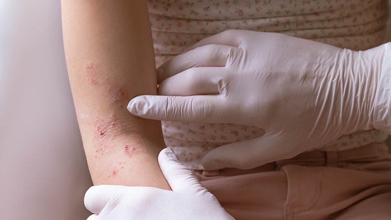 Kids With Skin Diseases Face Stigma, Reduced Quality of Life