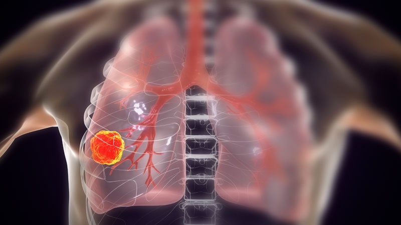 'Groundbreaking' Lung Cancer Trial Shows Survival Benefits