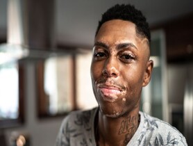 photo of vitiligo