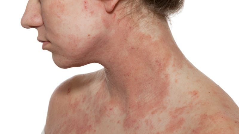 Rituximab, Belimumab Show Similar Lupus Disease Control